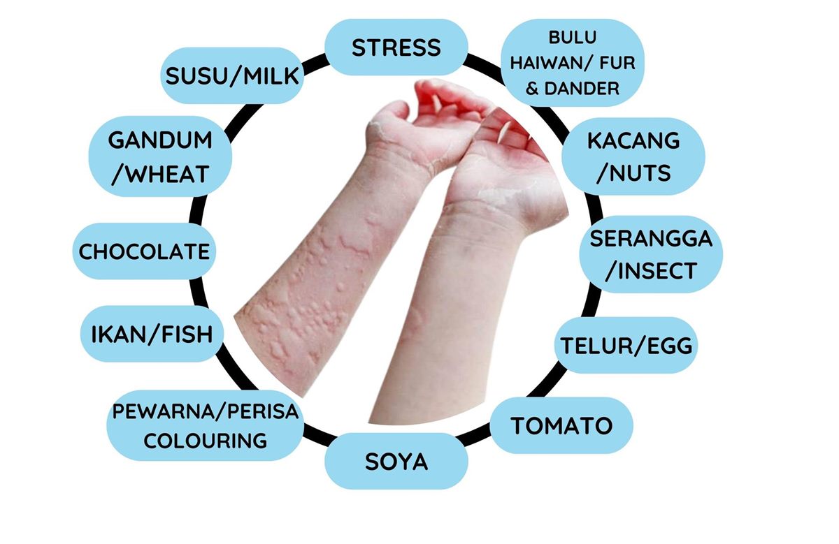 Punca alahan biasa: makanan, bulu haiwan, serangga dan lain-lain