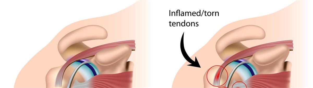 Perbandingan bahu normal dan masalah rotator cuff